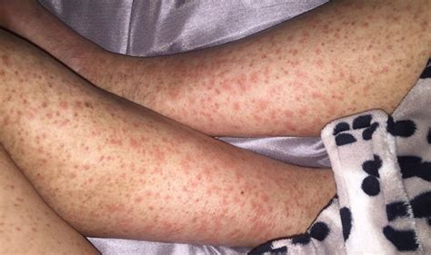 Cancer Symptoms ‘shaving Rash’ On Woman’s Legs Turned Out To Be Rare