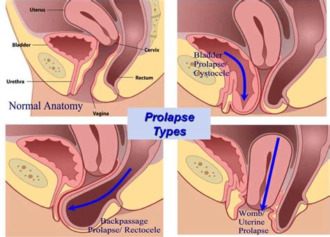 7 best rectal uterus prolapse health images on pinterest