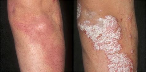 psoriasis  treatments excellent results msr news