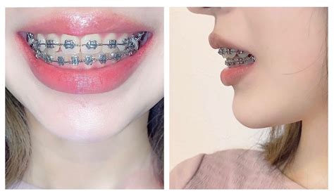 pin by eaffy kongsakul on สียางจัดฟัน braces colors braces tips