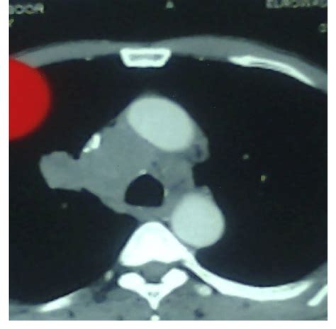 Ct Chest Showing Lung Mass With Enlarged Paratracheal Lymph Nodes