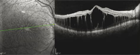 enhanced  cone syndrome   nre related retinal dystrophies