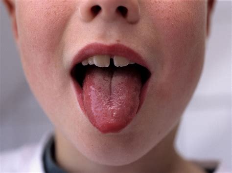 Scarlet Fever Outbreak Fears What Are The Symptoms What Treatment Is