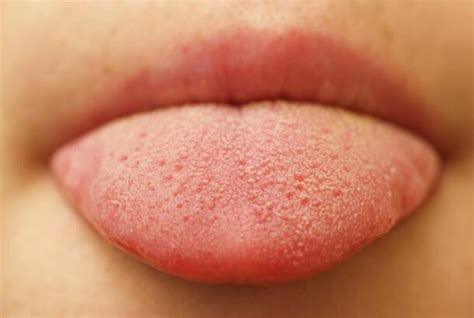swollen tongue symptoms  treatments