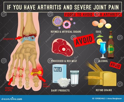 arthritis foods image stock vector illustration  rheumatologic