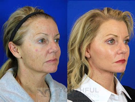 Co2 Laser Skin Resurfacing Before And After Photos Patient 95 Nashville