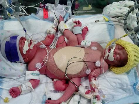 Texas Mom Delivers Conjoined Twins Who Are Also Rare