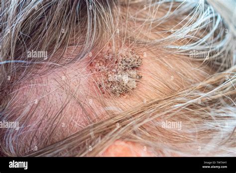 seborrheic keratosis  scalp treatment sexiz pix
