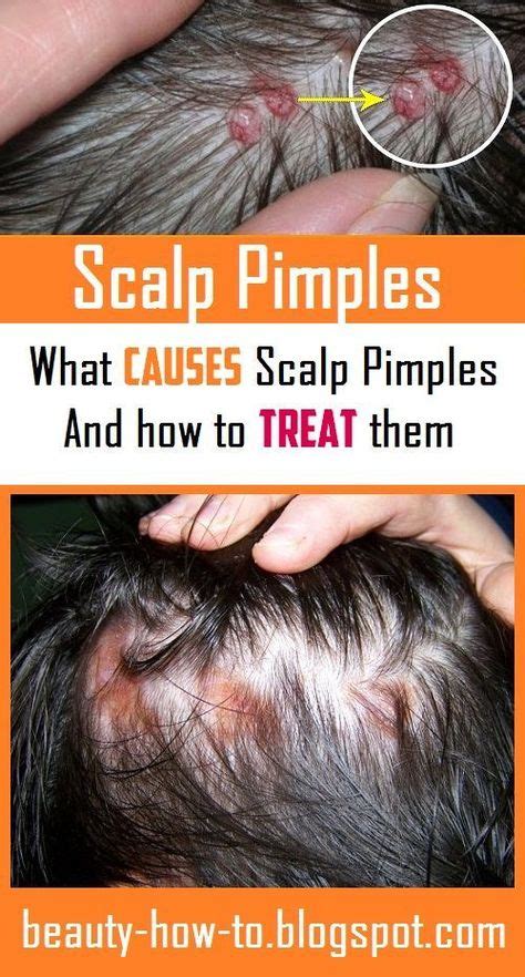 scalp pimples what causes them and how to treat t pimples scalp my
