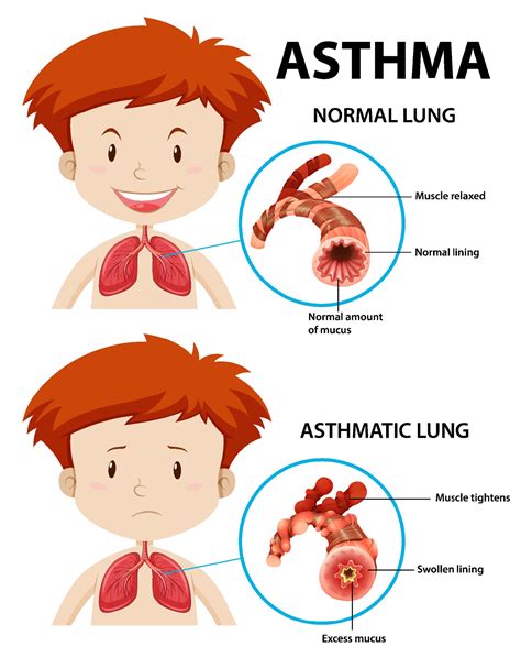 asthma diagram  normal lung  asthmatic lung  vector art