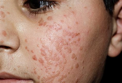 warts  face   locations    effective treatment med warts