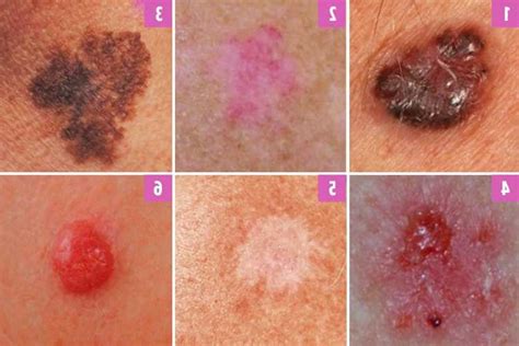 Can You Spot Which Moles Are Deadly The Skin Cancer Signs You Need To