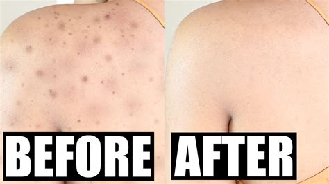 How To Get Rid Of Acne Scars Permanently Skinovative