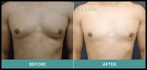Gynecomastia Surgery Results Crown Clinic