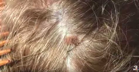 woman s hairstylist noticed a deadly mole on client s scalp