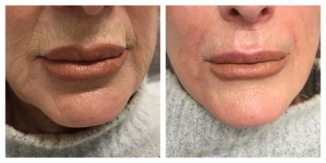 Before And After Skin And Cosmetics Treatment
