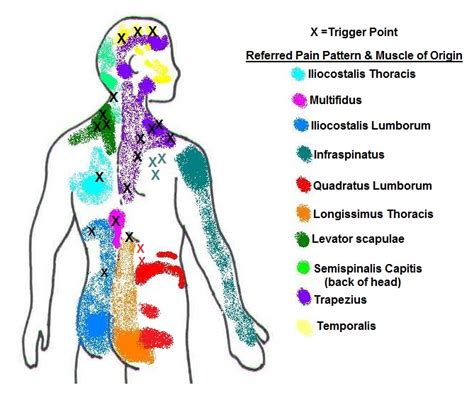 Referred Pain Patterns From The Back Neck And Shoulder
