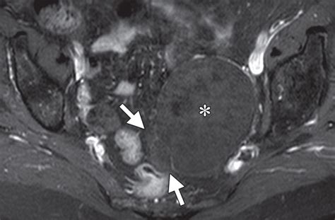 Imaging Strategy For Early Ovarian Cancer Characterization Of Adnexal