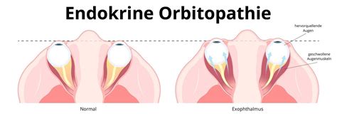 exophthalmus ursachen symptome diagnose behandlung