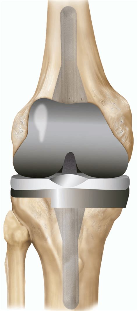 joint replacements osteoarthritis max superspecialty ortho clinic