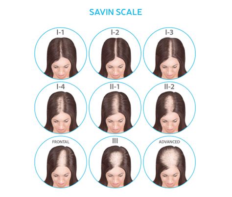 female pattern hair loss lifestyle pharmacy
