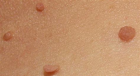 top causes of skin tags laser lipo and veins