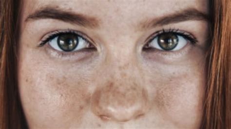 skin pigmentation   prevention
