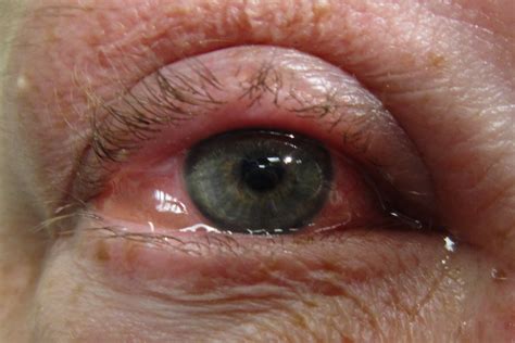 allergic eye disease itching    eyeonoptics