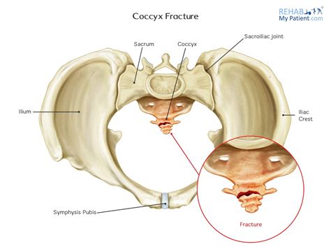 coccyx fracture rehab  patient