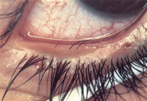 chromosome mutation gave elizabeth taylor double eyelashes