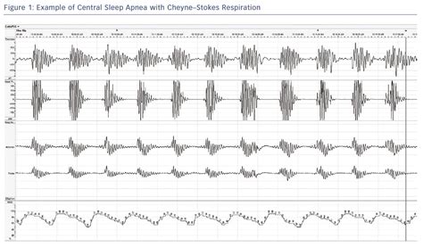 figure    central sleep apnea  cheynestokes respiration