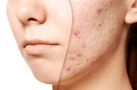 acne fighting facial idan med spa
