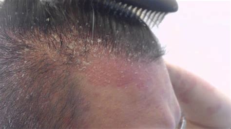 scalp psoriasis hair loss pictures