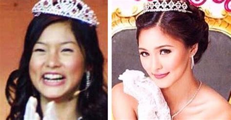 Watch Kim Chiu Addresses The Nose Job Issue Again