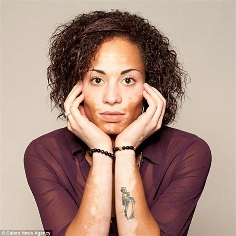 Vitiligo Sufferer Says Grandmas Dying Words Helped Her Daily Mail Online