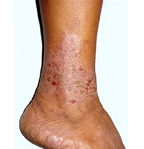 stasis dermatitis pictures symptoms  treatment diagnosis hubpages