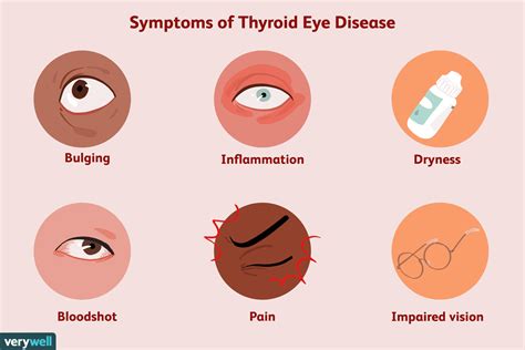 thyroid eye disease signs symptoms and complications