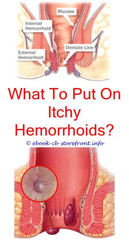 17 impressive hemorrhoid relief it works ideas external hemorrhoids