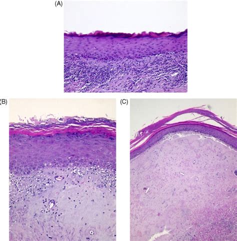 lichen sclerosus of the male genitalia and urethra surgical options