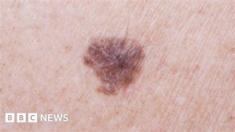 Arm Mole Skin Cancer Test Dermatologist Veronique Bataille Explains