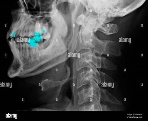 normale hws roentgen stockfotografie alamy