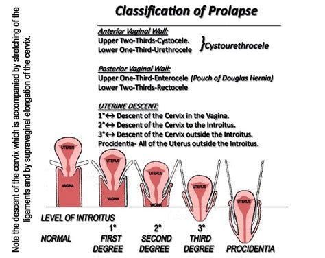Grading A Prolapse Your Pessary Uterine Prolapse Pelvic Floor