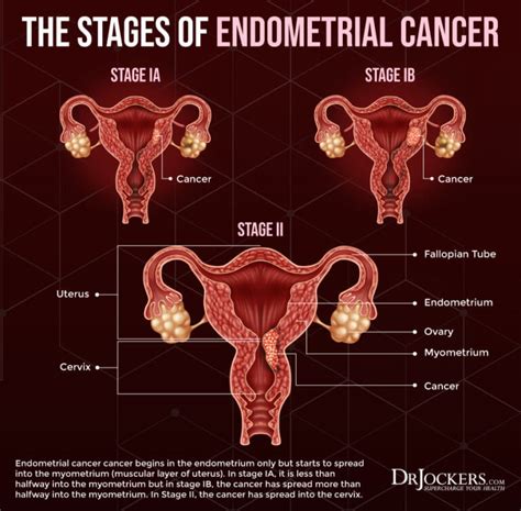 Endometrial Cancer Symptoms Causes And Support Strategies