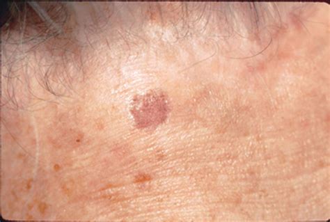 examples  skin cancer spots