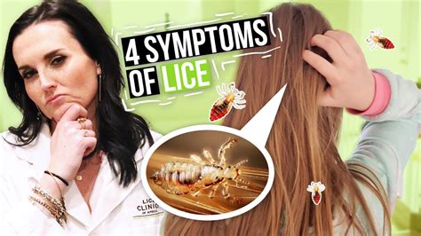 Head Lice Symptoms And Treatment 4 Signs Of Lice To Watch For Youtube