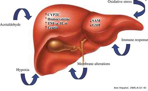 Alcoholic Liver Disease An Update Annals Of Hepatology