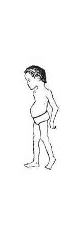 Malnourished Malnutrition Child Where Hesperian Normal Weakness Sad Places Think Looks Children Most But Small Size May sketch template