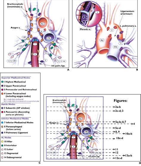 Ct Depiction Of Regional Nodal Stations For Lung Cancer Staging