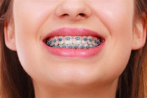 metal braces orthodontist whitby braces whitby invisalign whitby