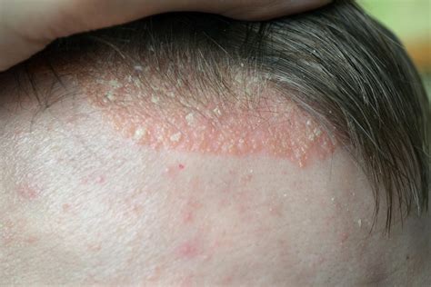 reasons   itchy scalp  head lice  healthy